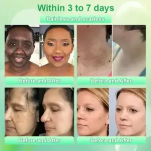 Jorondy™ Purifying Exfoliating Gel for Acanthosis Nigricans