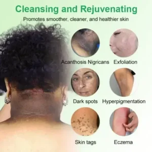 Jorondy™ Purifying Exfoliating Gel for Acanthosis Nigricans