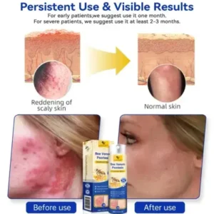 LOVILDS™ PsoriaHeal Psoriasis Spray Pro