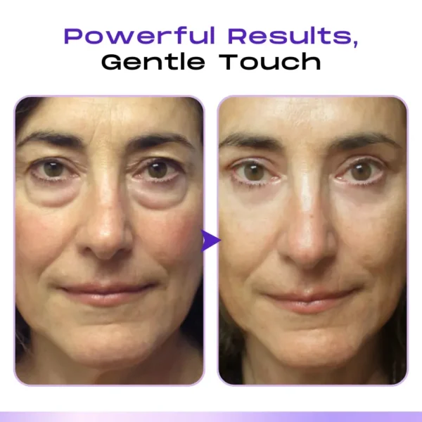 LOVILDS™ CollagenVen Bee Venom Eye Roller Serum-👨‍⚕️US Dermatologist Approved