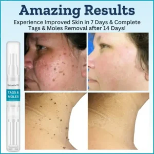 Skinetiv™ Tags & Moles Corrector