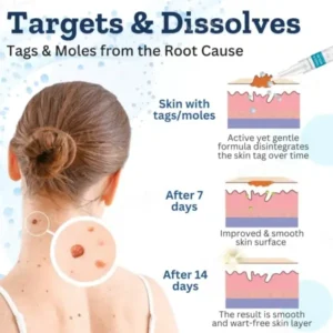 Skinetiv™ Tags & Moles Corrector