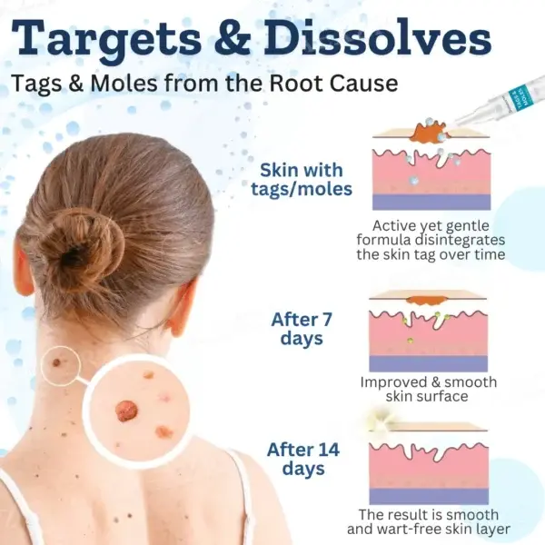 Skinetiv™ Tags & Moles Corrector