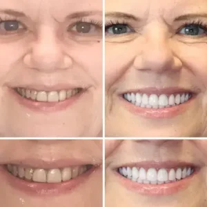 HZA™ –🦷Advanced Customized Full Denture Set
