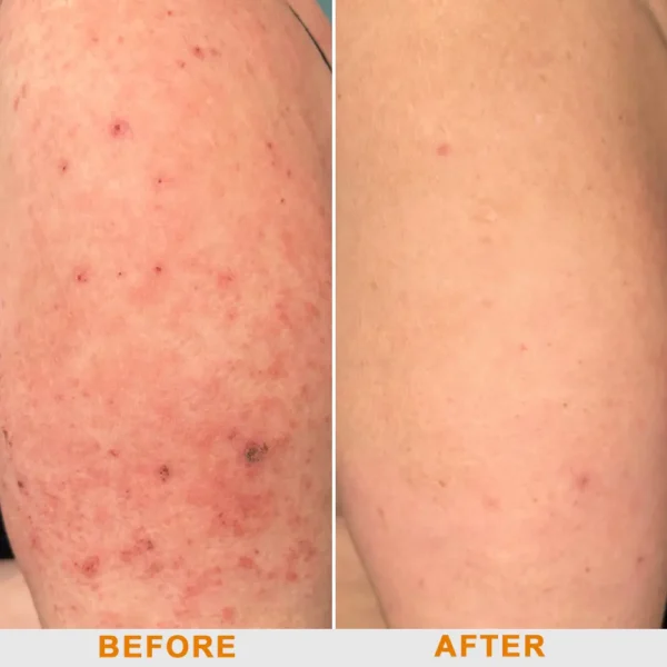 Ourlyard® Official Store: Bee Venom Skin Treatment Cream👨‍⚕️British Association of Dermatologists (BAD) Approved
