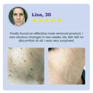 Oveallgo® Clarivine Dissolver Mole & Dark Spot Removal Bio-Gel