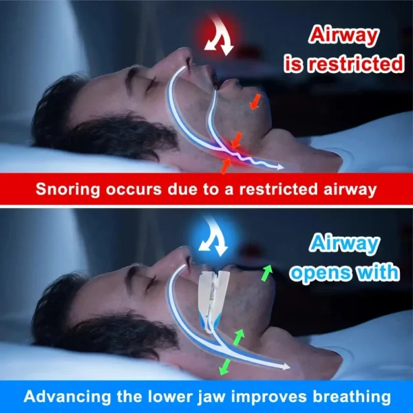 ZenSleep® – Say Goodbye to Snoring and Enjoy Peaceful Nights