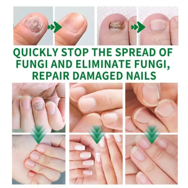 AQA™ - Ginger Nail Treatment Nail Support Nail Care👨‍⚕️
