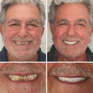 Custom-Fit Functional Dentures