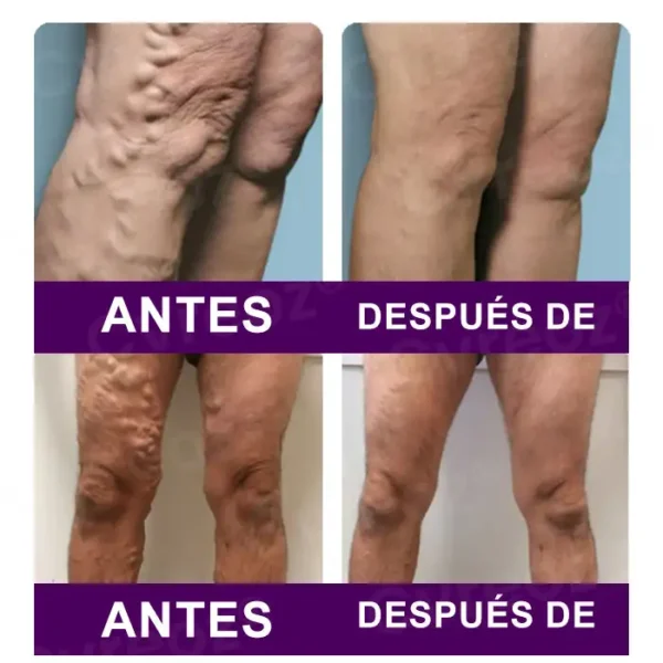 Cvreoz® Nanoparches de polidocanol para las varices