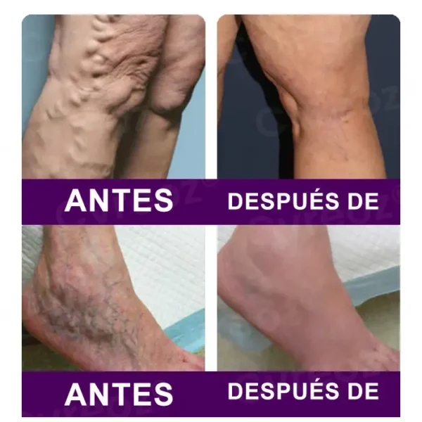 Cvreoz® Nanoparches de polidocanol para las varices