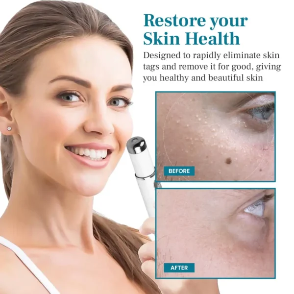 DIYSTAR™ LumeSkin Mole and Wart Removal Laser Pen