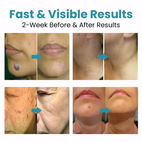 Lovilds® Non-Invasive Mole and Wart Removal Laser Pen