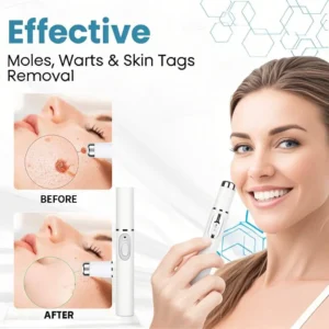 Lovilds® Non-Invasive Mole and Wart Removal Laser Pen