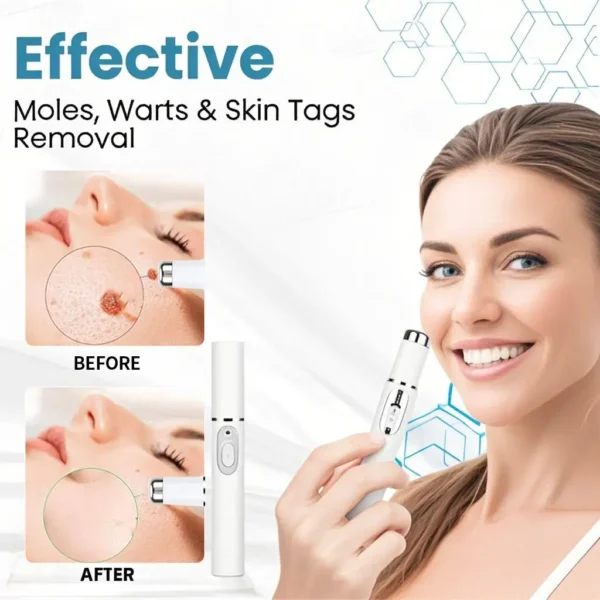 Lovilds® Non-Invasive Mole and Wart Removal Laser Pen