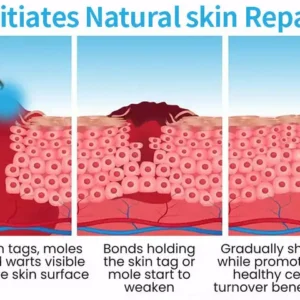 Lovilds® Non-Invasive Mole and Wart Removal Laser Pen