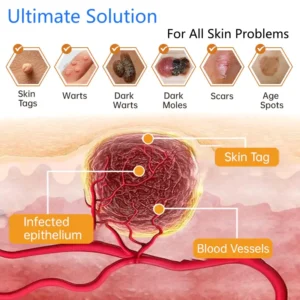 Lovilds® Non-Invasive Mole and Wart Removal Laser Pen