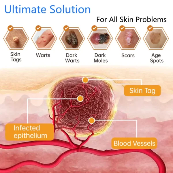 Lovilds® Non-Invasive Mole and Wart Removal Laser Pen