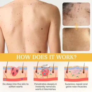 Oveallgo® EX DermaErase Advanced Mole & Spot Removal Gel