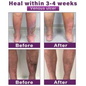 Seurico™ Polidocanol Nano Varicose Vein Relief Patch 👩🏼‍⚕️ Clinically Recommended by NICE (National Institute for Health and Care Excellence)