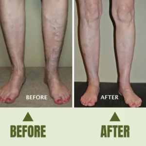 Timilk® Varicose Veins Healing Cream