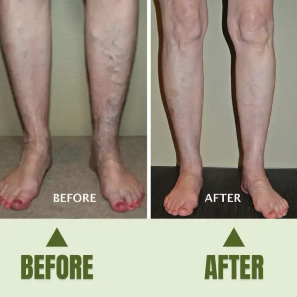 Timilk® Varicose Veins Healing Cream