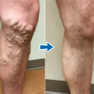Timilk® VenoAid Varicose Solution Spray