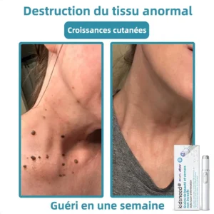 𝐤𝐢𝐝𝐬𝐧𝐞𝐞𝐝®⚡ 𝑺𝒕𝒚𝒍𝒐 𝑳𝒂𝒔𝒆𝒓 𝑵𝒐𝒏 𝑰𝒏𝒗𝒂𝒔𝒊𝒇 𝒑𝒐𝒖𝒓 𝒍'É𝒍𝒊𝒎𝒊𝒏𝒂𝒕𝒊𝒐𝒏 𝒅𝒆𝒔 𝑮𝒓𝒂𝒊𝒏𝒔 𝒅𝒆 𝑩𝒆𝒂𝒖𝒕é 𝒆𝒕 𝒅𝒆𝒔 𝑽𝒆𝒓𝒓𝒖𝒆𝒔🔥