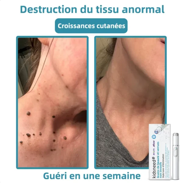 𝐤𝐢𝐝𝐬𝐧𝐞𝐞𝐝®⚡ 𝑺𝒕𝒚𝒍𝒐 𝑳𝒂𝒔𝒆𝒓 𝑵𝒐𝒏 𝑰𝒏𝒗𝒂𝒔𝒊𝒇 𝒑𝒐𝒖𝒓 𝒍'É𝒍𝒊𝒎𝒊𝒏𝒂𝒕𝒊𝒐𝒏 𝒅𝒆𝒔 𝑮𝒓𝒂𝒊𝒏𝒔 𝒅𝒆 𝑩𝒆𝒂𝒖𝒕é 𝒆𝒕 𝒅𝒆𝒔 𝑽𝒆𝒓𝒓𝒖𝒆𝒔🔥