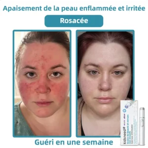 𝐤𝐢𝐝𝐬𝐧𝐞𝐞𝐝®⚡ 𝑺𝒕𝒚𝒍𝒐 𝑳𝒂𝒔𝒆𝒓 𝑵𝒐𝒏 𝑰𝒏𝒗𝒂𝒔𝒊𝒇 𝒑𝒐𝒖𝒓 𝒍'É𝒍𝒊𝒎𝒊𝒏𝒂𝒕𝒊𝒐𝒏 𝒅𝒆𝒔 𝑮𝒓𝒂𝒊𝒏𝒔 𝒅𝒆 𝑩𝒆𝒂𝒖𝒕é 𝒆𝒕 𝒅𝒆𝒔 𝑽𝒆𝒓𝒓𝒖𝒆𝒔🔥