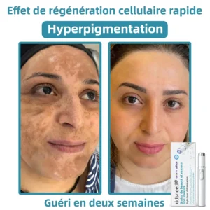 𝐤𝐢𝐝𝐬𝐧𝐞𝐞𝐝®⚡ 𝑺𝒕𝒚𝒍𝒐 𝑳𝒂𝒔𝒆𝒓 𝑵𝒐𝒏 𝑰𝒏𝒗𝒂𝒔𝒊𝒇 𝒑𝒐𝒖𝒓 𝒍'É𝒍𝒊𝒎𝒊𝒏𝒂𝒕𝒊𝒐𝒏 𝒅𝒆𝒔 𝑮𝒓𝒂𝒊𝒏𝒔 𝒅𝒆 𝑩𝒆𝒂𝒖𝒕é 𝒆𝒕 𝒅𝒆𝒔 𝑽𝒆𝒓𝒓𝒖𝒆𝒔🔥