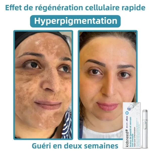 𝐤𝐢𝐝𝐬𝐧𝐞𝐞𝐝®⚡ 𝑺𝒕𝒚𝒍𝒐 𝑳𝒂𝒔𝒆𝒓 𝑵𝒐𝒏 𝑰𝒏𝒗𝒂𝒔𝒊𝒇 𝒑𝒐𝒖𝒓 𝒍'É𝒍𝒊𝒎𝒊𝒏𝒂𝒕𝒊𝒐𝒏 𝒅𝒆𝒔 𝑮𝒓𝒂𝒊𝒏𝒔 𝒅𝒆 𝑩𝒆𝒂𝒖𝒕é 𝒆𝒕 𝒅𝒆𝒔 𝑽𝒆𝒓𝒓𝒖𝒆𝒔🔥