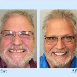 HEATWOLF® – Premium Customized Full Denture Set🦷-🏆🏆The Royal London Dental Hospital accreditation(🏆Limited Time Discount Last 30 Minutes🏆)