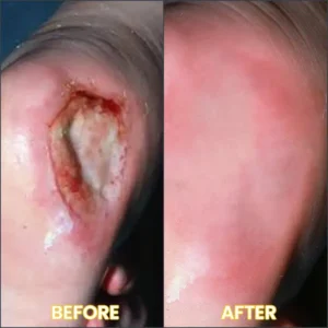 LIMETOW® Bedsore Cream