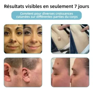 kidsneed® Stylo Laser Non Invasif pour l'Élimination des Grains de Beauté et des Verrues 🖊️