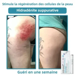 kidsneed® Stylo Laser Non Invasif pour l'Élimination des Grains de Beauté et des Verrues 🖊️