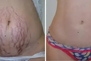 AEXZR™ Advanced Scar Spray