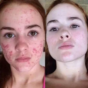 AEXZR™ Advanced Scar Spray