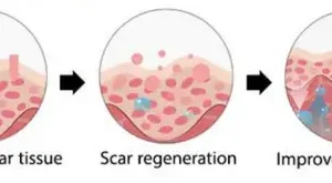 AEXZR™ Advanced Scar Spray