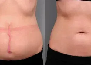 AEXZR™ Advanced Scar Spray