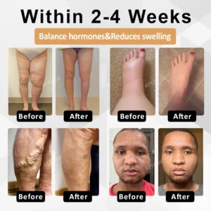 ATTDX® CortiEase Hormonal Swelling Balance Cream