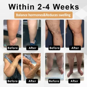 ATTDX® CortiEase Hormonal Swelling Balance Cream