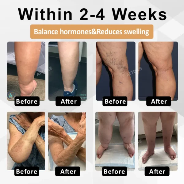 ATTDX® CortiEase Hormonal Swelling Balance Cream