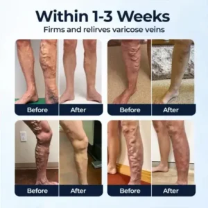 CVREOZ® Varicose Veins Spray
