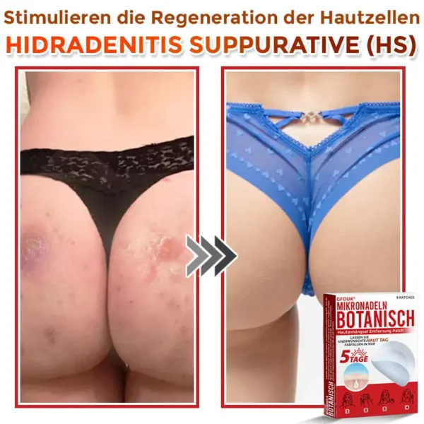 GFOUK® Mikronadeln Botanisch Hautanhängsel Entfernung Patch