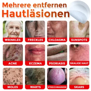 GFOUK® Mikronadeln Botanisch Hautanhängsel Entfernung Patch
