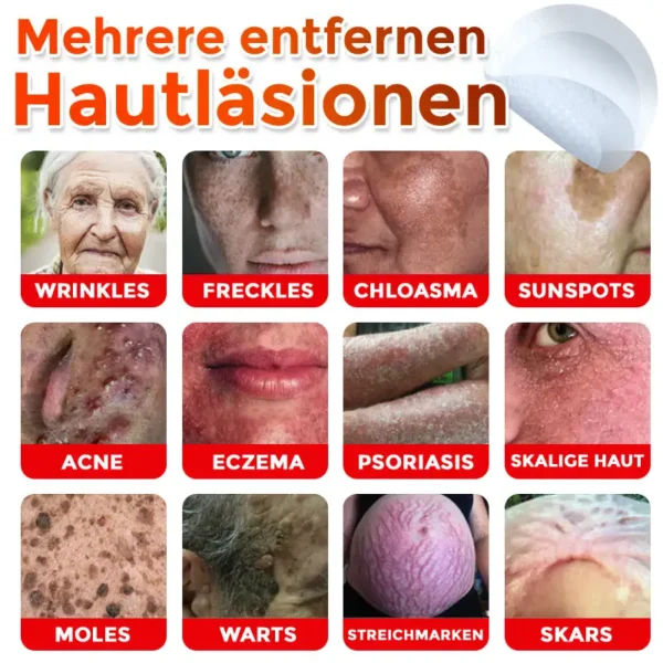 GFOUK® Mikronadeln Botanisch Hautanhängsel Entfernung Patch