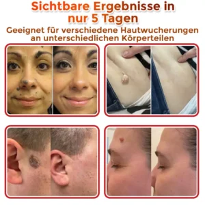 GFOUK® Mikronadeln Botanisch Hautanhängsel Entfernung Patch