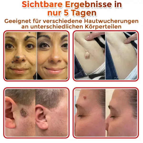 GFOUK® Mikronadeln Botanisch Hautanhängsel Entfernung Patch