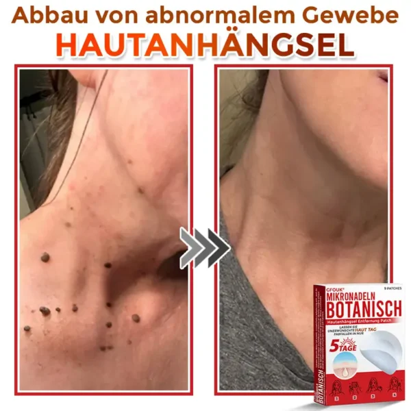 GFOUK® Mikronadeln Botanisch Hautanhängsel Entfernung Patch